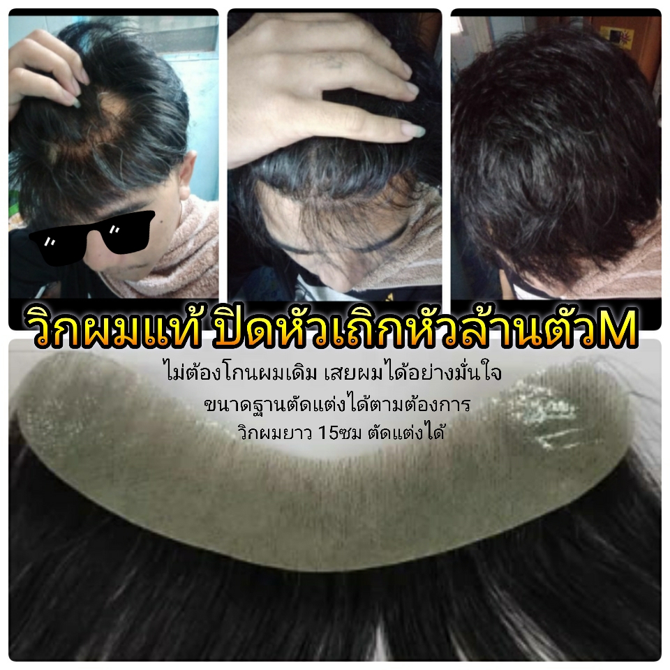 แผ่นปิดหัวเถิก เสยผมได้ วิกผมแท้ปิดหัวล้านตัวเอ็ม หัวล้านตัวM
