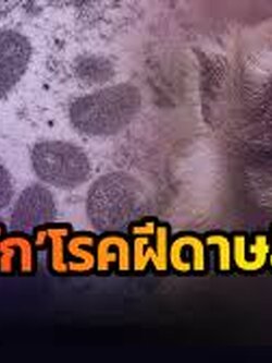 ทำความรู้จัก โรคฝีดาษลิง